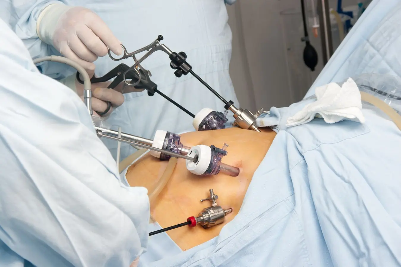 Gastric Sleeve in Mexico vs USA: Cost, Safety, and Results