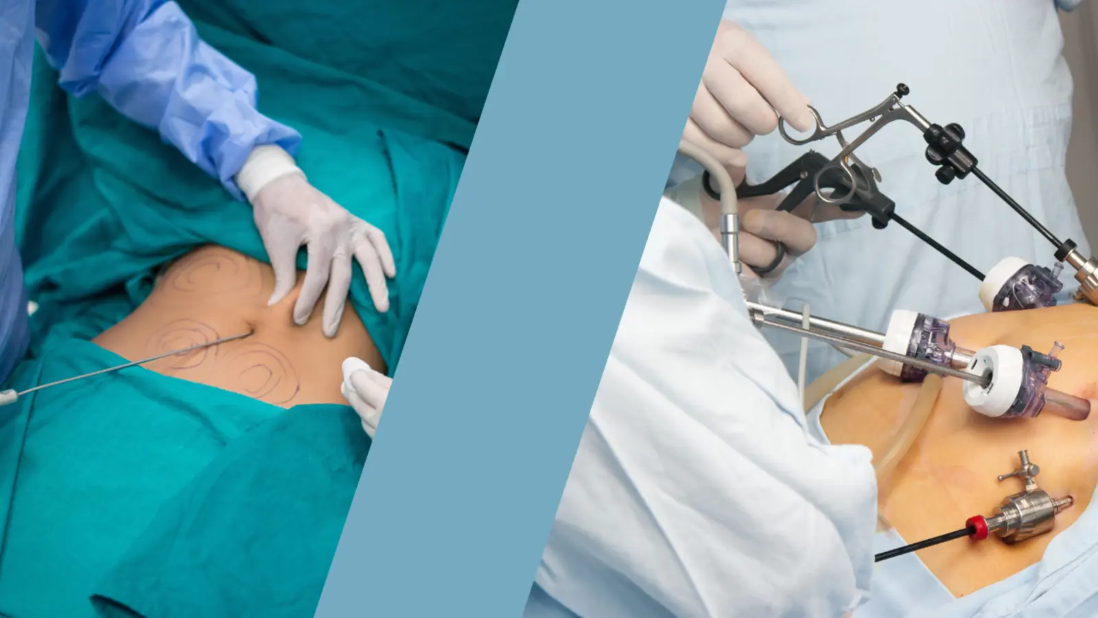 Can Bariatric Surgery Reverse Type 2 Diabetes?