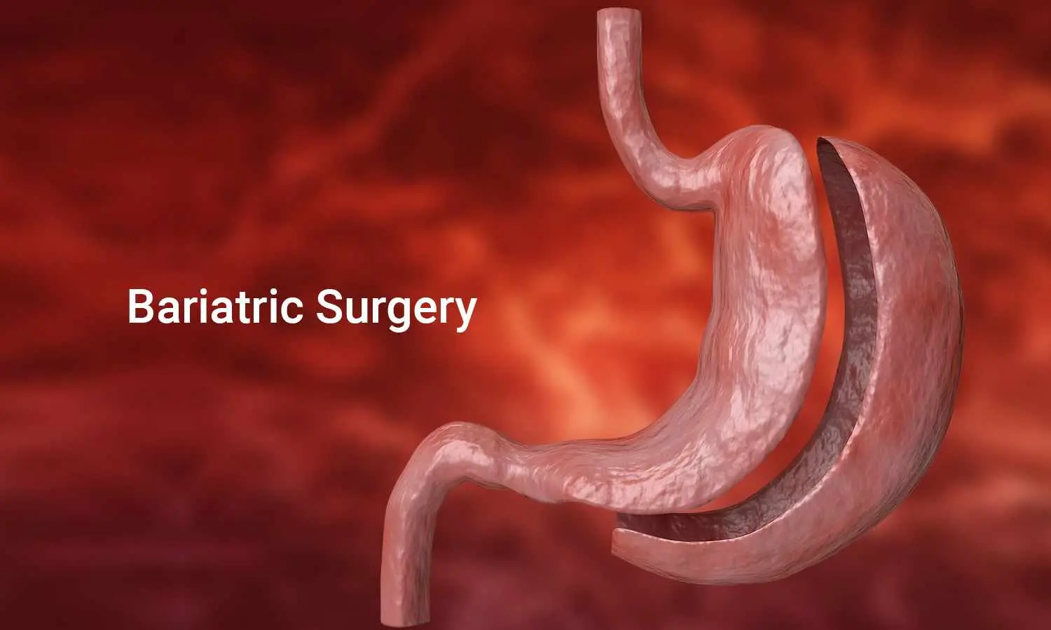 Gastric Sleeve Surgery: Real Patient Results and Success Stories