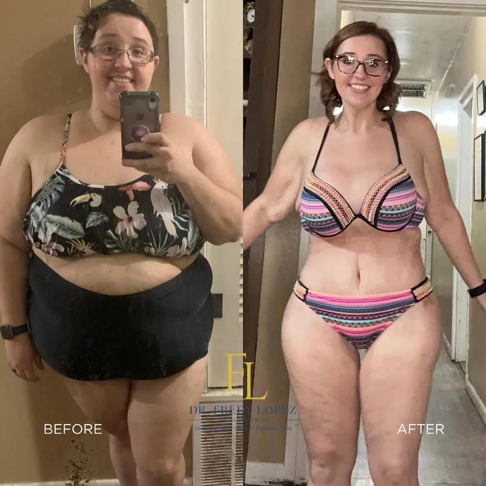 Patient before and after bariatric surgery