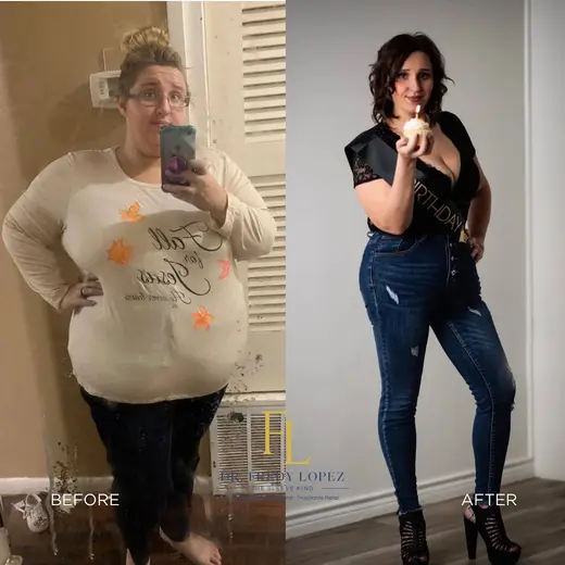 Patient before and after bariatric surgery