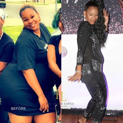 Patient before and after bariatric surgery