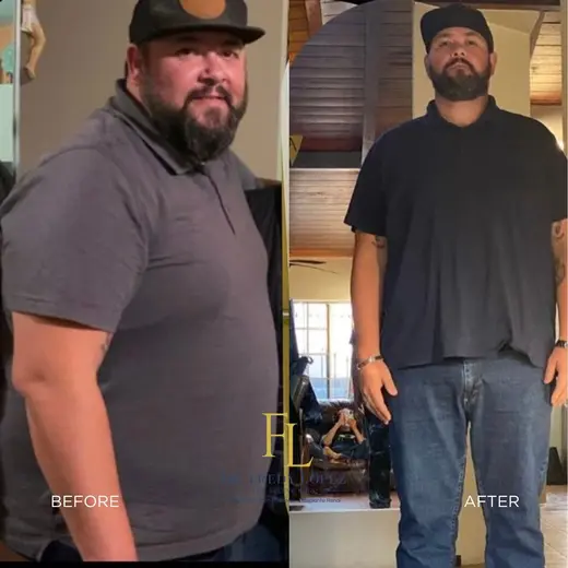 Patient before and after bariatric surgery