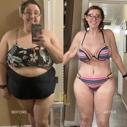 Patient before and after bariatric surgery