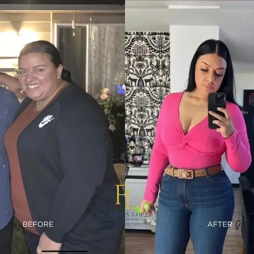 Patient before and after bariatric surgery